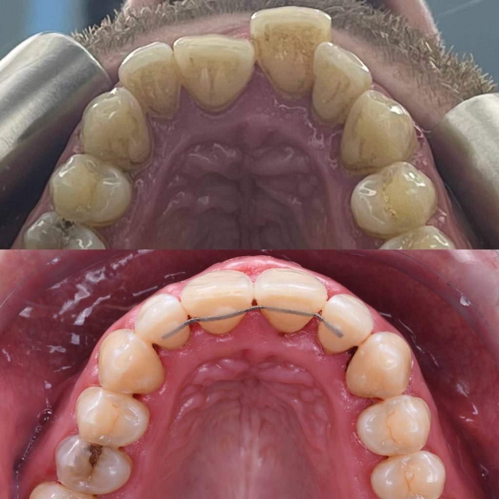 28 years old male with severe crowding