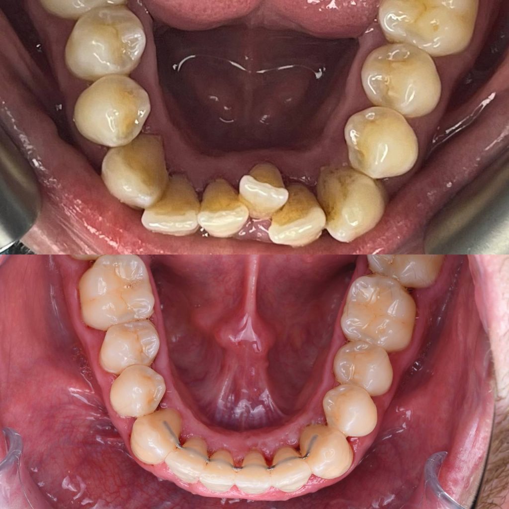 28 years old male with severe crowding